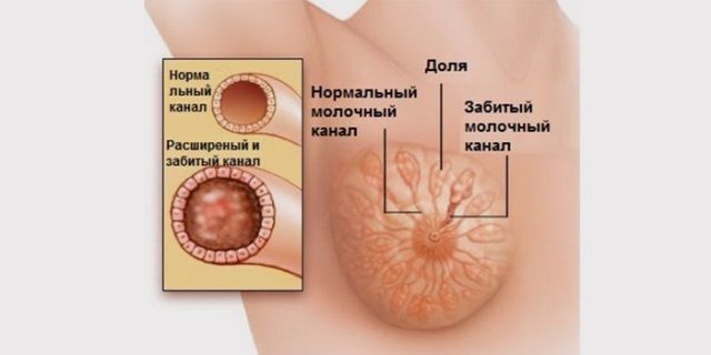 Лактостаз. Негнойный мастит Лактостаз. Негнойный мастит