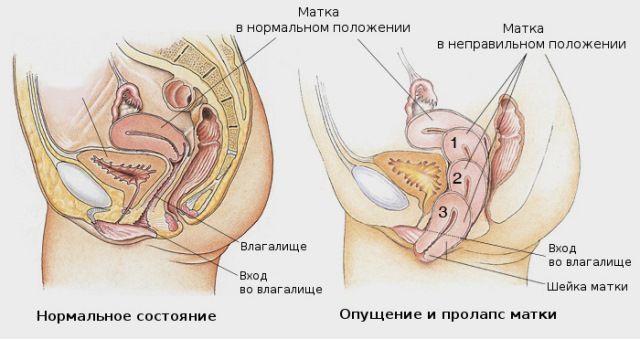 Опущение и выпадение стенок влагалища и матки Опущение и выпадение стенок влагалища и матки