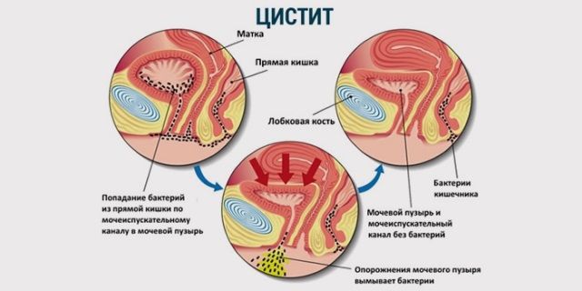 Лечение цистита Лечение цистита